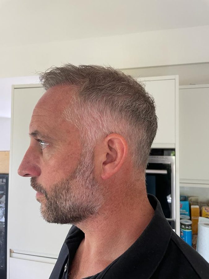 Patient-submitted photograph of grown FUE result, side view