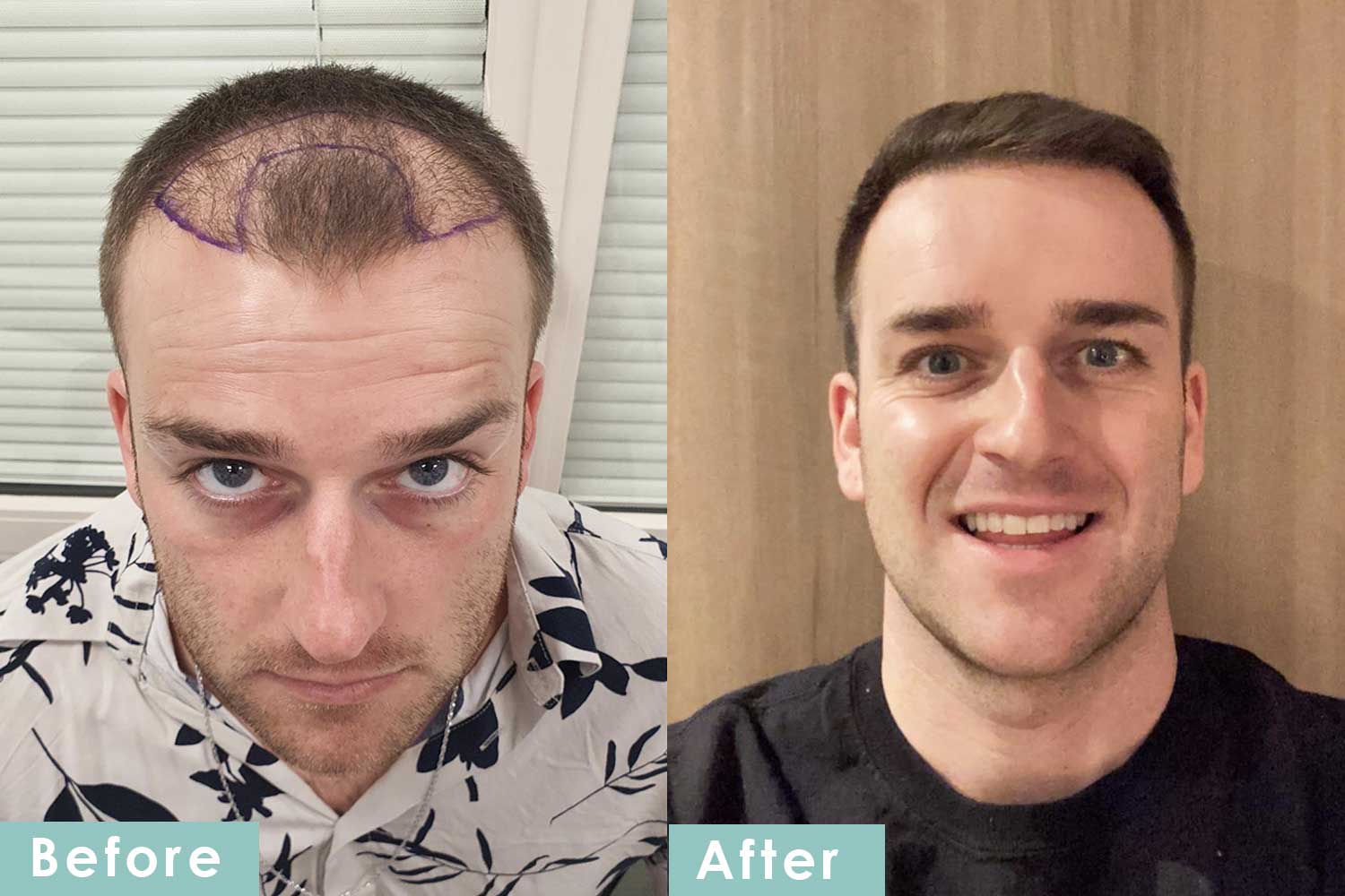 Hair Transplant Before and After Images | Hair Transplantation Images