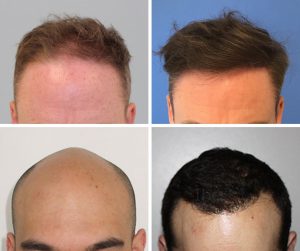 hair transplant before and after