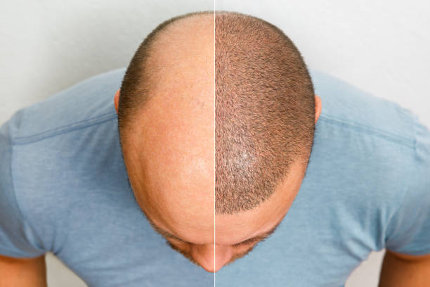 before and after