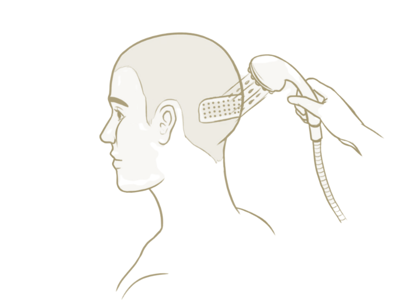 illustration how to wash your hair after fue hair transplant