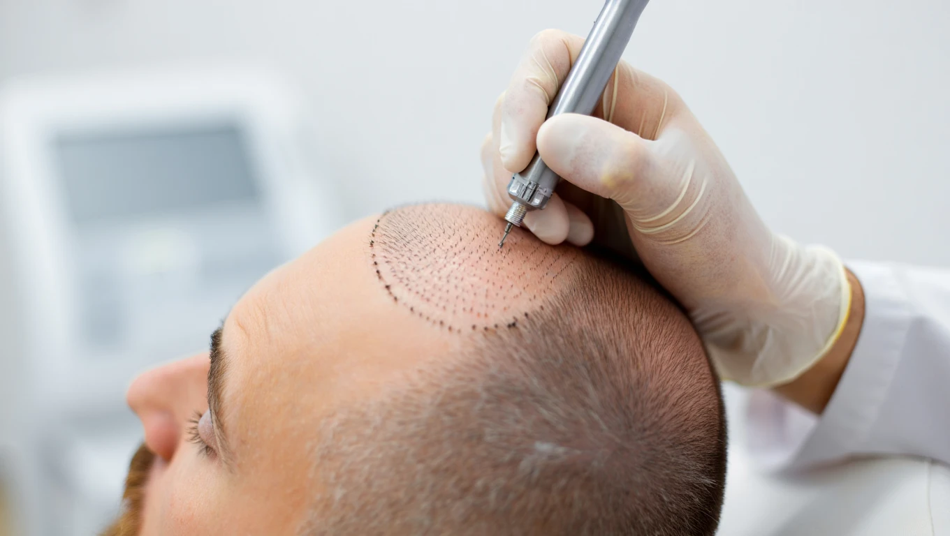 SMP Scalp Micro Pigmentation