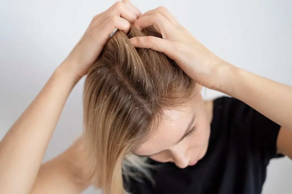 Scalp Infections